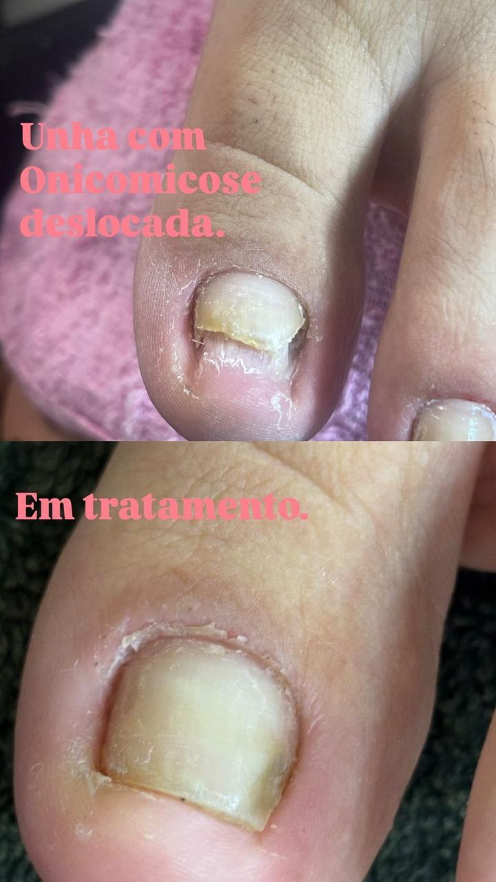 Montagem da Nicole: em cima, unha do dedão amarelada e descolada por onicomicose; embaixo, a mesma unha em tratamento, mais clara e aderida