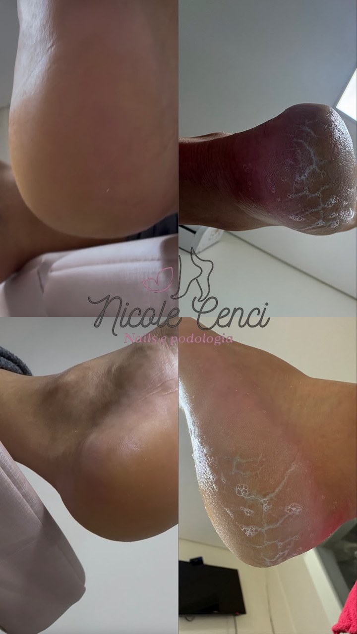 Montagem da Nicole com quatro fotos de calcanhar: pele rachada com fissuras e pele lisa depois do atendimento
